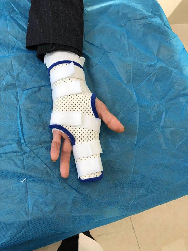 腕部低温（指骨骨折）